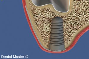 osteo integration