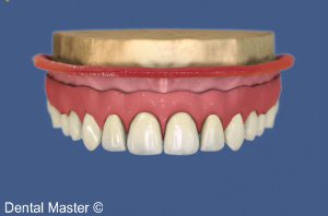 La prothèse amovible sur implants