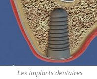 Les implants dentaires